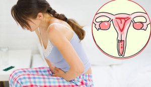 Bệnh viêm cổ tử cung làm tăng nguy cơ ung thư cổ tử cung