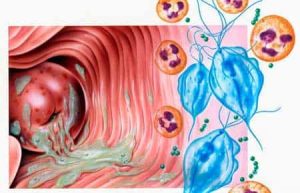 Hình ảnh viêm âm đạo do vi khuẩn