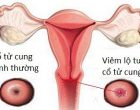 viêm lộ tuyến cổ tử cung là gì