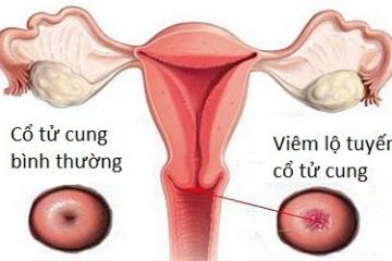 viêm lộ tuyến cổ tử cung là gì