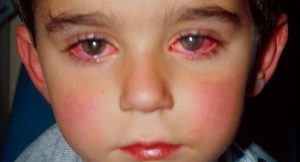 đau mắt đỏ ở trẻ nhỏ