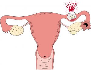 Những biến chứng của thai ngoài tử cung