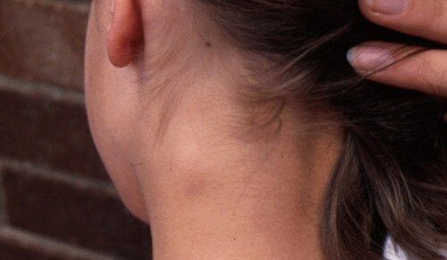 hạch bạch huyết ở cổ